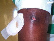 Staph Infection