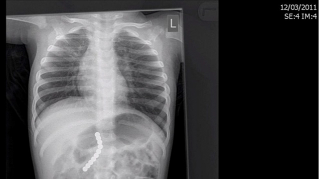 PHOTO: X-ray of magnets lodged in digestive tract