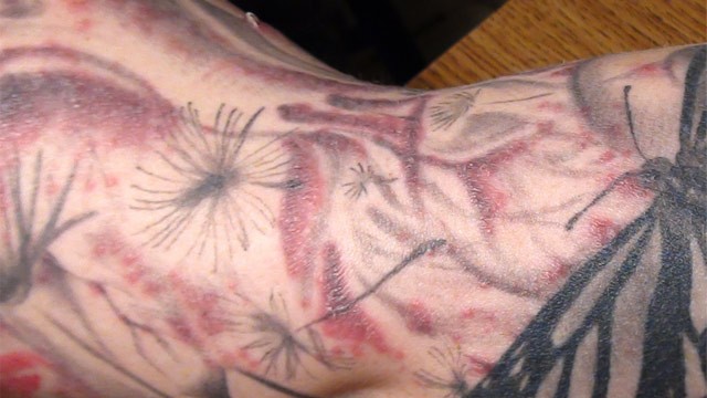 PHOTO: Tattoo ink skin infection