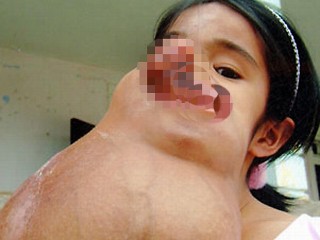 tumor