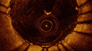 PHOTO An image of a heart vessel taken from an Optical Coherence Tomography is shown.