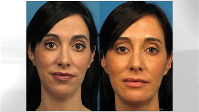 PHOTO: Triana Lavey, before and after plastic surgery to fix her