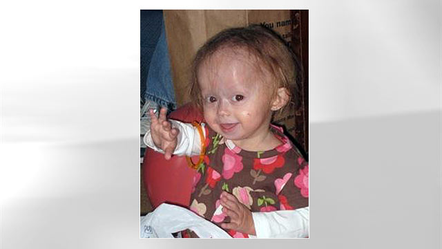 PHOTO: Zoey Penny suffers from a rare childhood condition known as Progeria disease. The disorder causes children to age 10 times faster than a normal person.