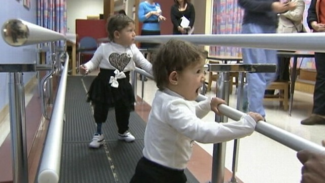 VIDEO: The 2-year-old girls born without functioning legs received care at a California hospital.