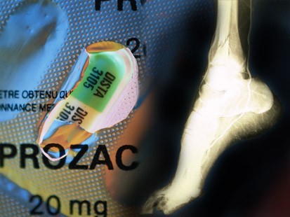 Prozac y otros ISRS favorecen la resorción ósea