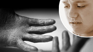 Photo: Skin Disorder Patients Cant Recognize Disgust: Study Finds Psoriasis Patients May Stop Recognizing Repulsive Looks
