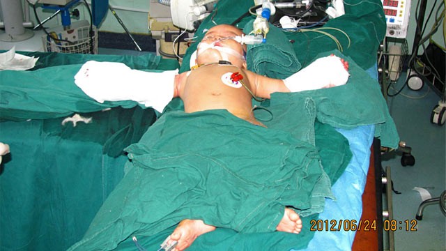 PHOTO: Baby girl recovering in hospital after hands reattached
