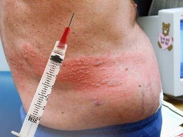 SHINGLES