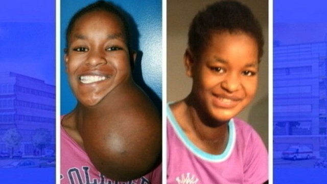 VIDEO: Aster Degano, 13, flew from Ethiopia to New York for surgery to remove the benign tumor.