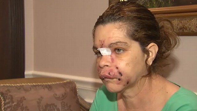 Video: Florida Woman Blames Spa for Botched Procedure