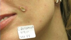 VIDEO: Georgia woman says cosmetic procedure burned a hole in her face and left a large scar.