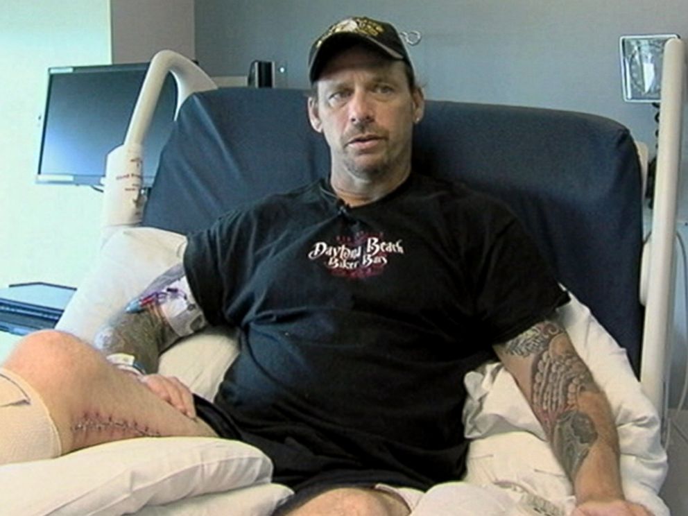 Man Loses Leg to FleshEating Bacteria After Wading in the Gulf of