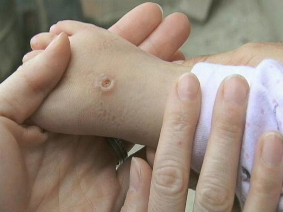 PHOTO: An 18-month-old girl from An Kang, China survived the Asian Hornet sting