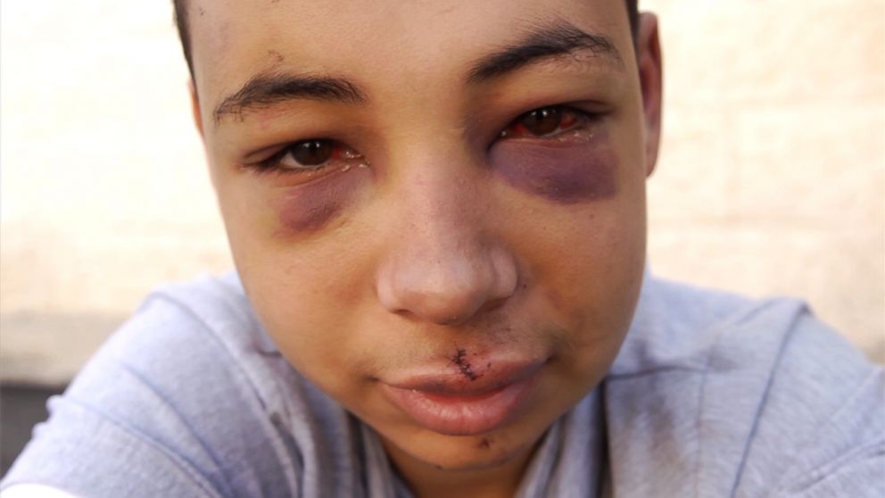 PHOTO: American teen Tariq Abu Khdeir, arrested by Israeli police, has been released from jail but is under house arrest.