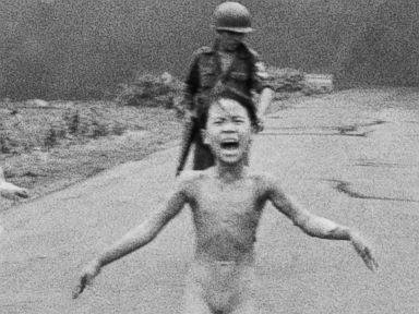 Vietnamese Woman Burned By Napalm Treated 40 Years Later