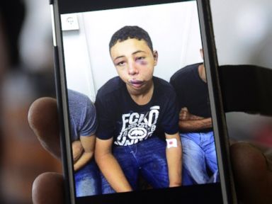 PHOTO: Suha Abu Khdeir shows a mobile phone photo of her son Tariq Abu Khdeir, taken in a hospital after he was beaten and arrested by the Israeli police during clashes Thursday, in Jerusalem, Saturday, July 5, 2014.