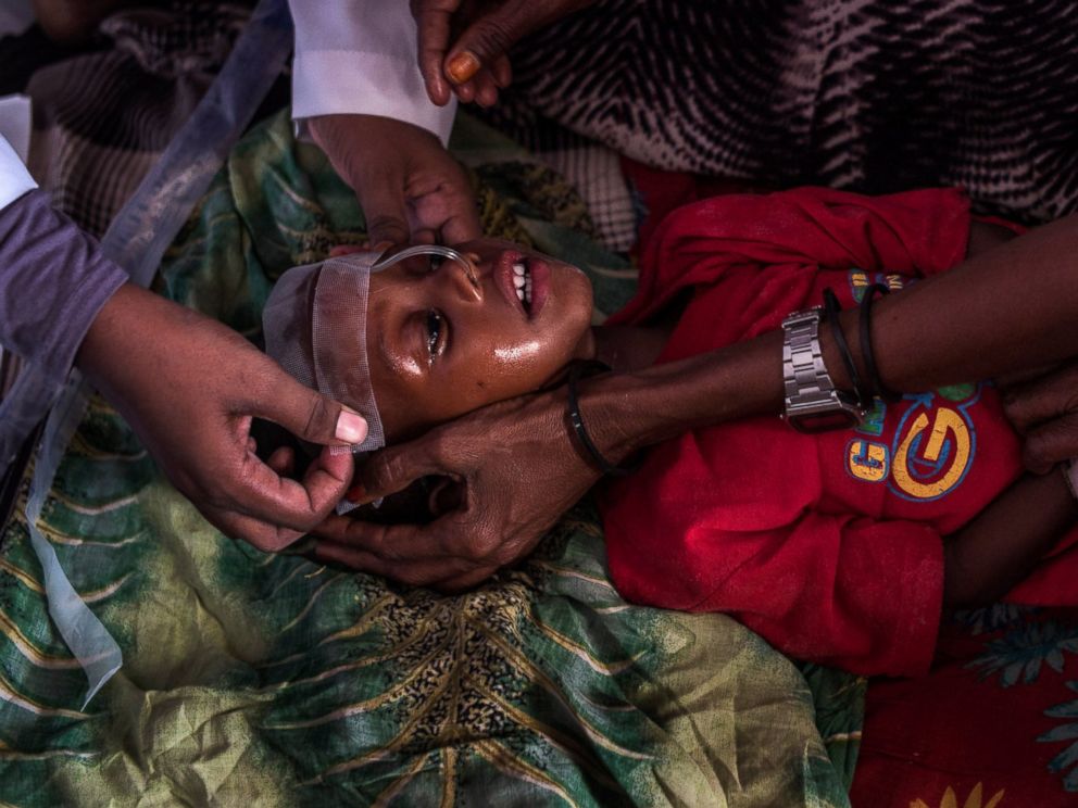 PHOTO: Medical staff treat a child suffering from malnutrition at Garowe General Hospital, Feb. 27, 2017, in Garowe, Somalia.