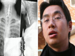 Hard To Swallow: Man Gulps Scissors