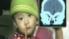 VIDEO: A young boy in China undergoes surgery to have a utensil removed from his nose.