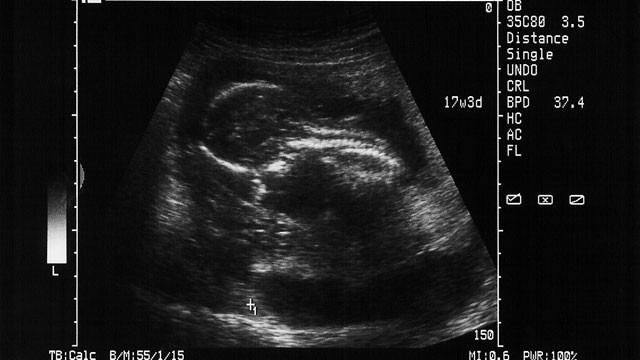 PHOTO: A new procedure lets parents test an embryo for possible life-threatening genetic defects before it is implanted into a woman's uterus.