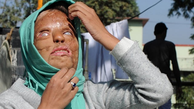 PHOTO: Acid attack survivor Sonali Mukherjee adjusts her headscarf in New Delhi, Dec. 6, 2012.