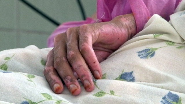PHOTO: 21-year old Wahida is recovering from self inflicted burns from trying to escape her abused life with her family and husband, Herat, Afghanistan.