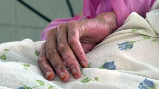 PHOTO: 21-year old Wahida is recovering from self inflicted burns from trying to escape her abused life with her family and husband, Herat, Afghanistan.