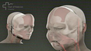 Spanish hospital says it has carried out the worlds first full-face transplant.