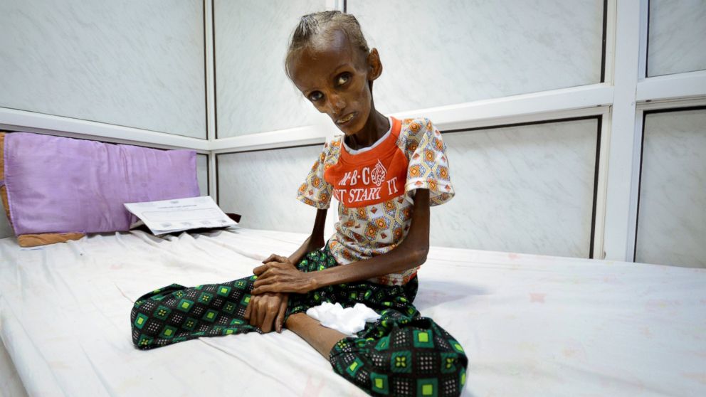 Images of Starving People in Yemen Help to Show the Horrors of War