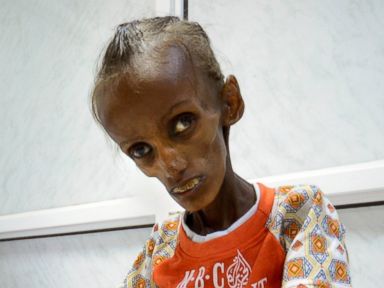 Images of Starving People in Yemen Show Horrors of War