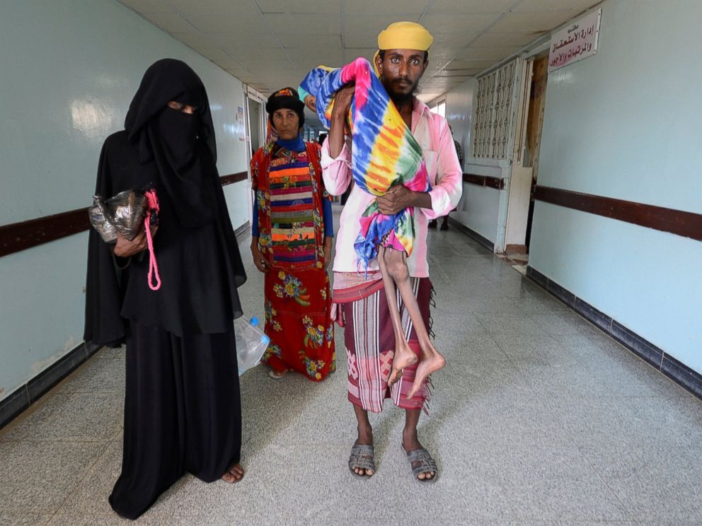 PHOTO: Saida Ahmad Baghili is carried by her cousin at the al-Thawra hospital where she is receiving treatment for severe acute malnutrition in the Red Sea port city of Houdieda, Yemen, Oct. 25, 2016. 