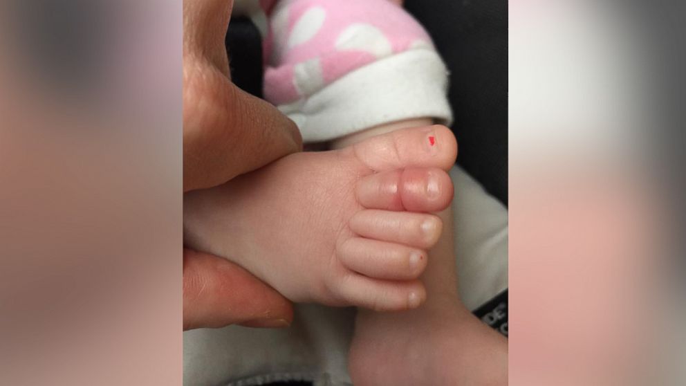 dad-s-viral-photo-of-baby-s-swollen-toe-raises-awareness-of-rare