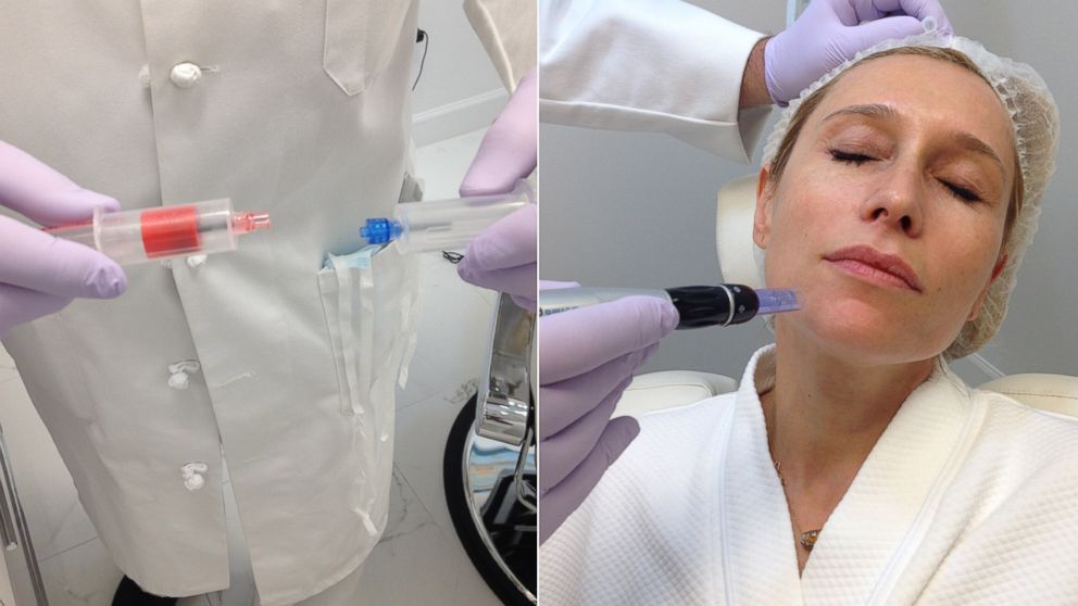 PHOTO: A "Blood Facial" at Esthetica MD combines the patients centrifuged plasma with calcium chloride