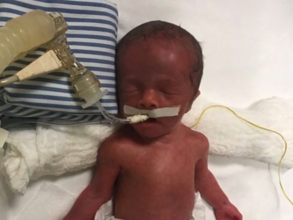 PHOTO: On the afternoon of July 18, 2007, Beckham Ralph was born just under 3 pounds via emergency c-section at Hospiten Cancun in Mexico, while his parents, Michaela Smith and Larry Ralph Jr. of Martinsville, Indiana, were vacationing.