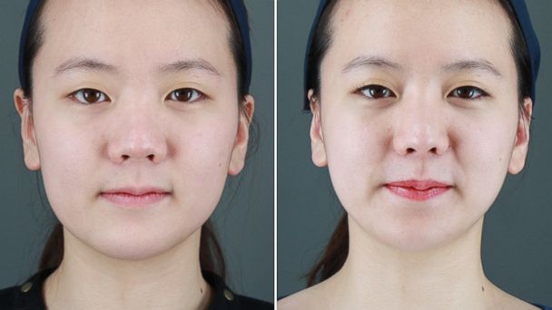 South Korea S Growing Obsession With Plastic Surgery Abc Los Angeles