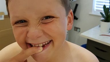 PHOTO: Sam Warren, 8, shows off his missing tooth.
