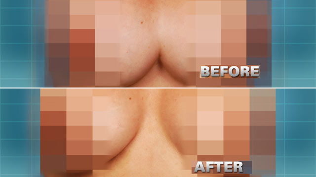PHOTO: Pictured here is Dinora Rodriguez, 40, whose repair of her breast implants left her with conjoined breasts due to a mistake in the procedure.