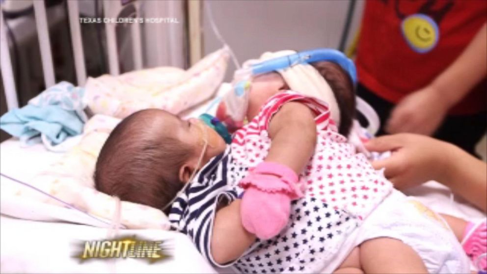 Conjoined Twins Living HearttoHeart Undergo Separation Surgery