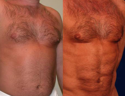 abs abs