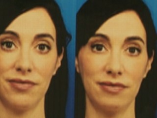 Watch: Woman Gets Chin Implant to Look Better Online