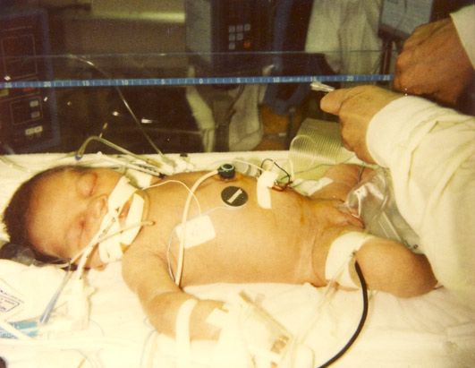  Hunsberger was born with a heart condition called aortic stenosis.