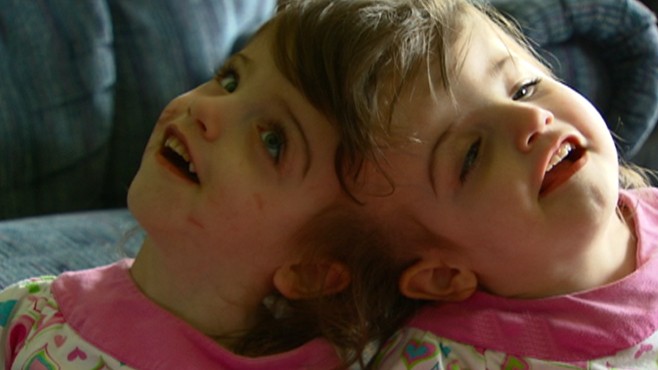 Conjoined Twins The Ultimate Bond Video Abc News