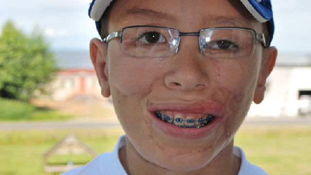 PHOTO: After flesh-eating bacterial infection threatened his life, Jake Finkbonner says he visited heaven and spoke to God.