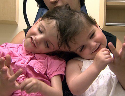 Twins Who Share A Brain