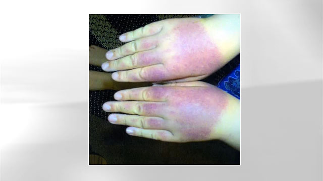 PHOTO: After removing his protective clothing while waiting in line for a rollercoaster ride at Six Flags, Leppert was immediately burned.