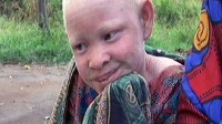 PHOTO Life for Tanzanians with Albinism: Gruesome Attacks, Extreme Sun Exposure, Dire Poverty