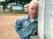 PHOTO Tanzanian Albinos Hunted Down