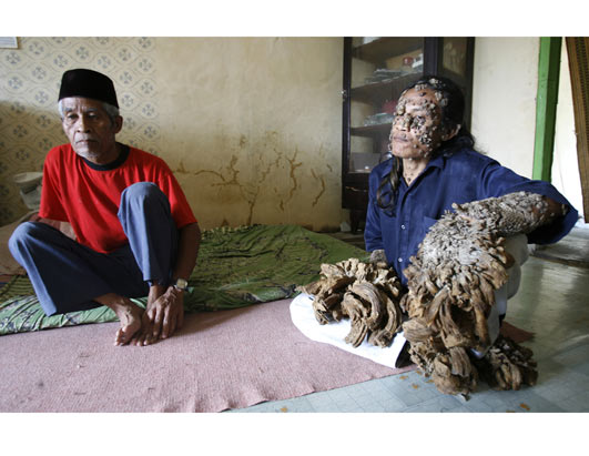 tree man pictures. #39;Tree Man#39; Heals in Indonesia