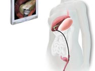 Vaginal Approach