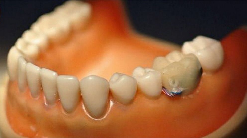 PHOTO: Tooth sensor